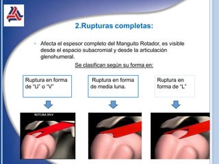 2.Rupturas completas:
𝗈 Afecta el espesor completo del Manguito Rotador, es visible
desde el espacio subacromial y desde la articulación
glenohumeral.
Se clasifican según su forma en:
Ruptura en forma
de “U” o “V”
Ruptura en forma
de media luna.
Ruptura en
forma de “L”
 