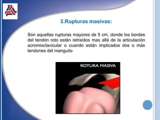 3.Rupturas masivas:
Son aquellas rupturas mayores de 5 cm, donde los bordes
del tendón roto están retraídos mas allá de la articulación
acromioclavicular o cuando están implicados dos o más
tendones del manguito
 