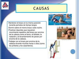 CAUSAS
𝗈Mantener el brazo en la misma posición
durante períodos de tiempo largos
𝗈Dormir sobre el mismo brazo cada noche.
𝗈Practicar deportes que requieren
movimiento repetitivo del brazo por encima
de la cabeza como el tenis, el béisbol, la
natación y el levantamiento de pesas por
encima de la cabeza.
𝗈Trabajar con el brazo por encima de la
cabeza durante muchas horas o días (como
los pintores y los carpinteros).
 