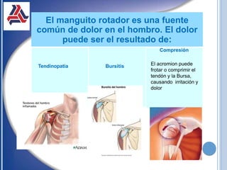 El manguito rotador es una fuente
común de dolor en el hombro. El dolor
puede ser el resultado de:
Tendinopatia Bursitis
Compresión
El acromion puede
frotar o comprimir el
tendón y la Bursa,
causando irritación y
dolor
 