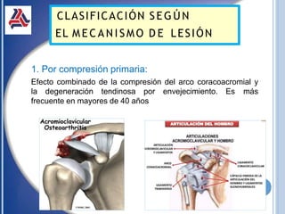 1. Por compresión primaria:
Efecto combinado de la compresión del arco coracoacromial y
la degeneración tendinosa por envejecimiento. Es más
frecuente en mayores de 40 años
CLASIFICACIÓN SEG ÚN
EL M E C A N I S M O D E LESIÓN
 