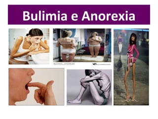 Bulimia e Anorexia
 