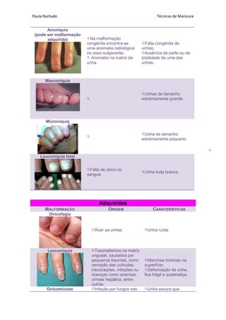 Paula Rachado Técnicas de Manicure
6
Anoniquia
(pode ser malformação
adquirida) Na malformação
congénita encontra-se
uma anomalia radiológica
no osso subjacente;
 Anomalia na matriz da
unha.
Falta congénita de
unhas;
Ausência de parte ou da
totalidade de uma das
unhas.
Macroniquia

Unhas de tamanho
extremamente grande.
Microniquia

Unha de tamanho
extremamente pequeno.
Leuconíquia total
Falta de zinco no
sangue.
Unha toda branca.
Adquiridas
MALFORMAÇÃO ORIGEM CARATERÍSTICAS
Onicofagia
Roer as unhas. Unha ruída.
Leuconíquia Traumatismos na matriz
ungueal, causados por
pequenos traumas, como
remoção das cutículas,
intoxicações, infeções ou
doenças como anemias,
cirrose hepática, entre
outras.
Manchas brancas na
superfície;
Deformação da unha,
fica frágil e quebradiça.
Onicomicose Infeção por fungos nas Unha escura que
 
