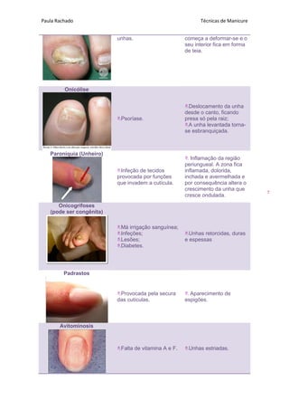 Paula Rachado Técnicas de Manicure
7
unhas. começa a deformar-se e o
seu interior fica em forma
de teia.
Onicólise
Psoríase.
Deslocamento da unha
desde o canto, ficando
presa só pela raiz;
A unha levantada torna-
se esbranquiçada.
Paroníquia (Unheiro)
Infeção de tecidos
provocada por funções
que invadem a cutícula.
 Inflamação da região
periungueal. A zona fica
inflamada, dolorida,
inchada e avermelhada e
por consequência altera o
crescimento da unha que
cresce ondulada.
Onicogrifoses
(pode ser congênita)
Má irrigação sanguínea;
Infeções;
Lesões;
Diabetes.
Unhas retorcidas, duras
e espessas
Padrastos
Provocada pela secura
das cutículas.
 Aparecimento de
espigões.
Avitominosis
Falta de vitamina A e F. Unhas estriadas.
 