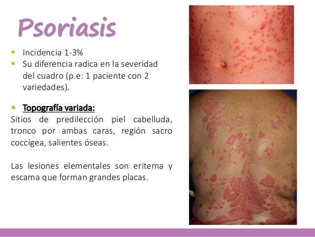 El ungüento de la eccema y las grietas