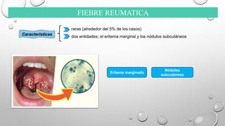 FIEBRE REUMATICA
Caracteristicas
raras (alrededor del 5% de los casos)
dos entidades; el eritema marginal y los nódulos subcutáneos
Eritema marginado
Nódulos
subcutáneos
 