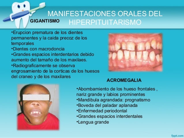 Manifestaciones orales en Enfermedades Endocrinas-Diabetes Manifestaciones orales en Enfermedades Endocrinas-Diabetes