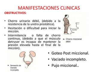 MANIFESTACIONES CLINICAS
OBSTRUCTIVOS:
• Chorro urinario débil, (debido a la
resistencia de la uretra prostática).
• Hesitación o dificultad para iniciar la
micción.
• Intermitencia o falta de chorro
continuo, (debido a que el músculo
detrusor es incapaz de mantener la
presión elevada hasta el final de la
micción).
• Goteo Post miccional.
• Vaciado incompleto.
• Pujo miccional..
 