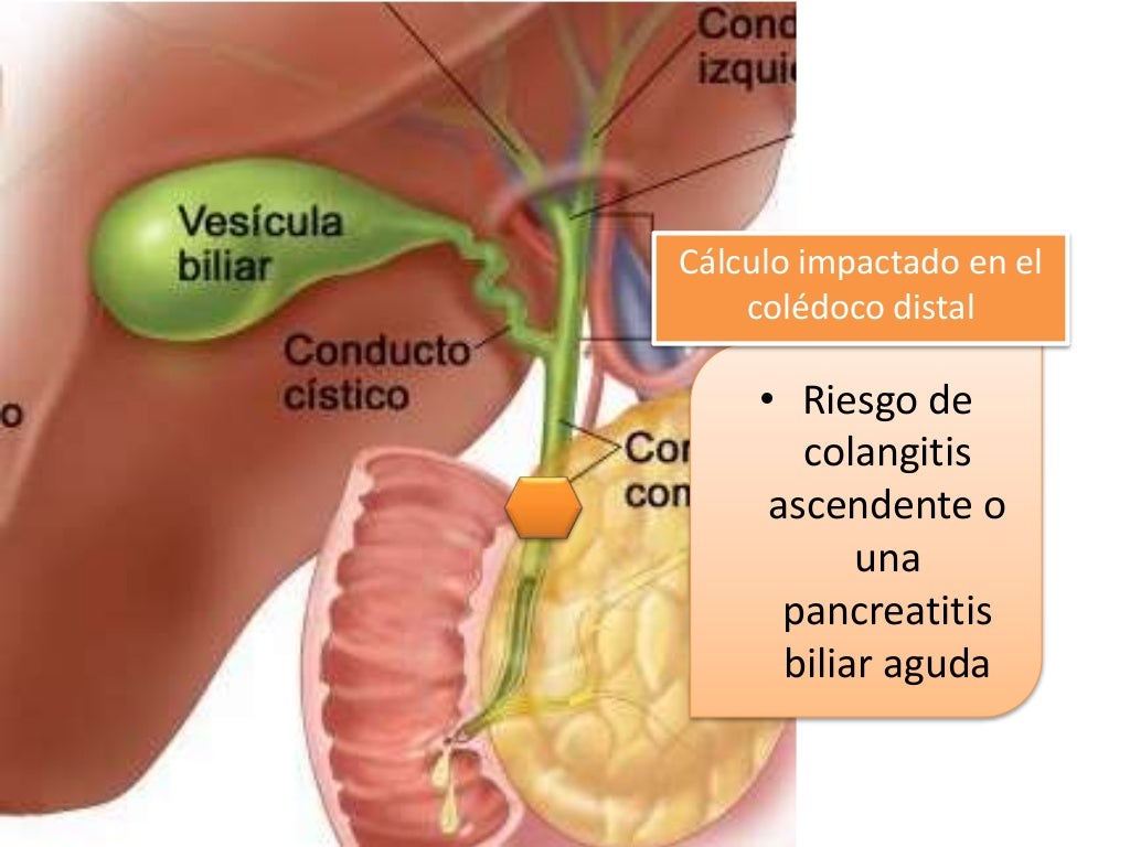 Patologia Biliar Colelitiasis Colecistitis Coledocolitiasis Images