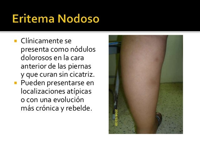 La eccema seca sobre las palmas de la foto la fase inicial que curar