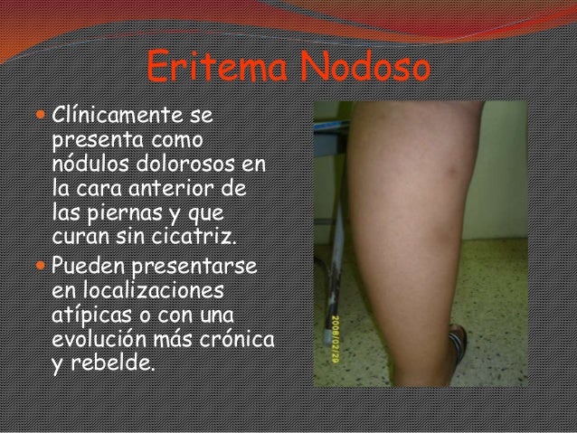 La psoriasis que es peligroso