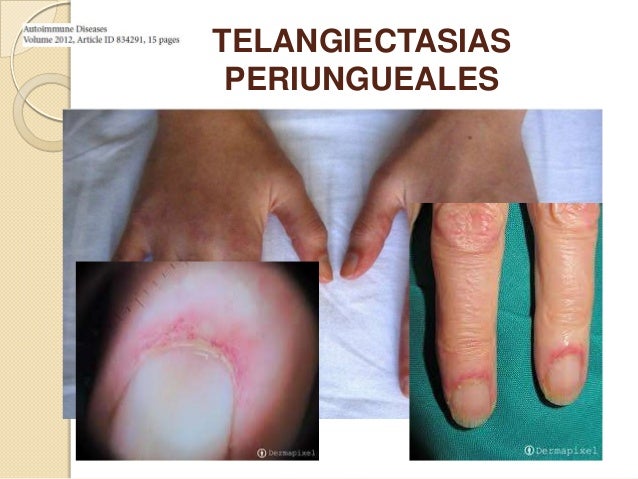 Resultado de imagen para telangiectasia periungueales