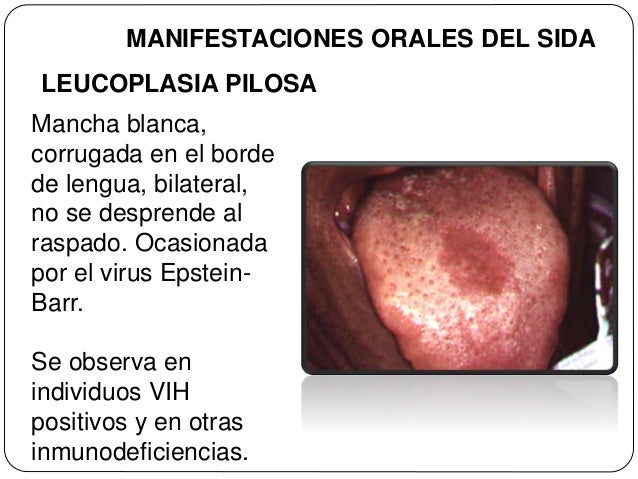 Manifestaciones orales del sida.