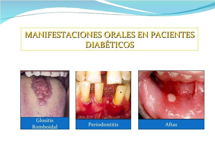 Manifestaciones orales en pacientes diabeticos Manifestaciones orales en pacientes diabeticos