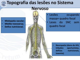 Topografia das lesões no Sistema
Nervoso
• Lesões ocupando
massa= quadro focal
• Leses do SNC sem
quadro focal
• Mielopatia vacular;
• Mielite transversa;
• Defice nutricional;
• Neuropatia (dano do HIV,
Infeções oportunistas,
defices nutricionais,
toxemia)
 