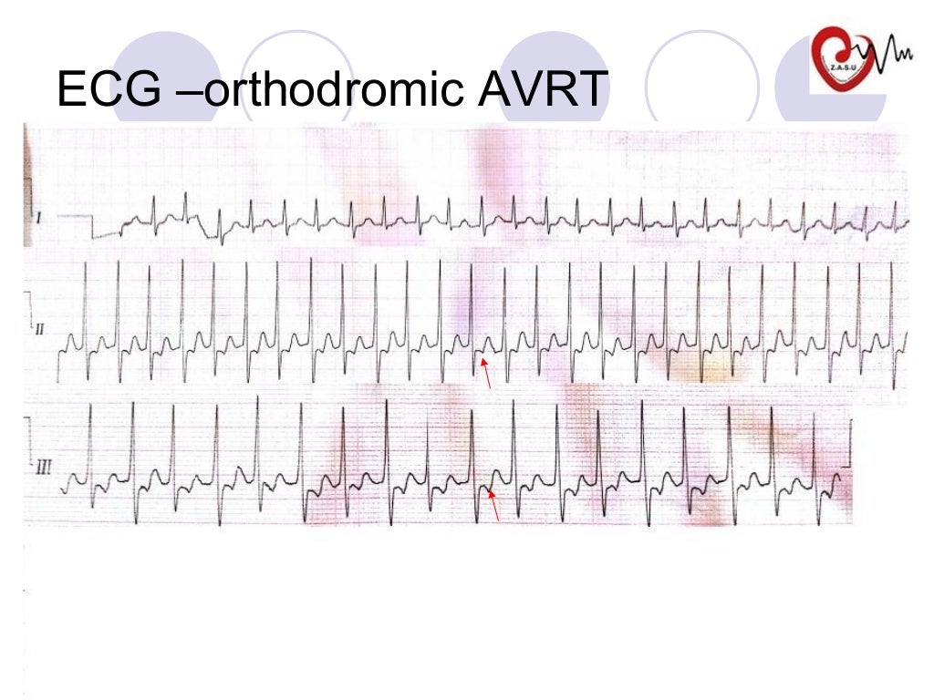 Manifest paraHisian accessory pathway (wpw) ablation our experience