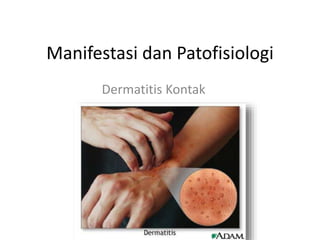 Manifestasi dan Patofisiologi
Dermatitis Kontak
 