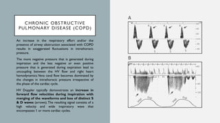 Manifestations of Cardiovascular Disorders on Doppler Interrogation of ...