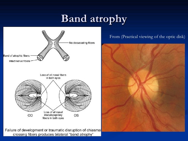 Anatomy and Lesions of Visual Pathways