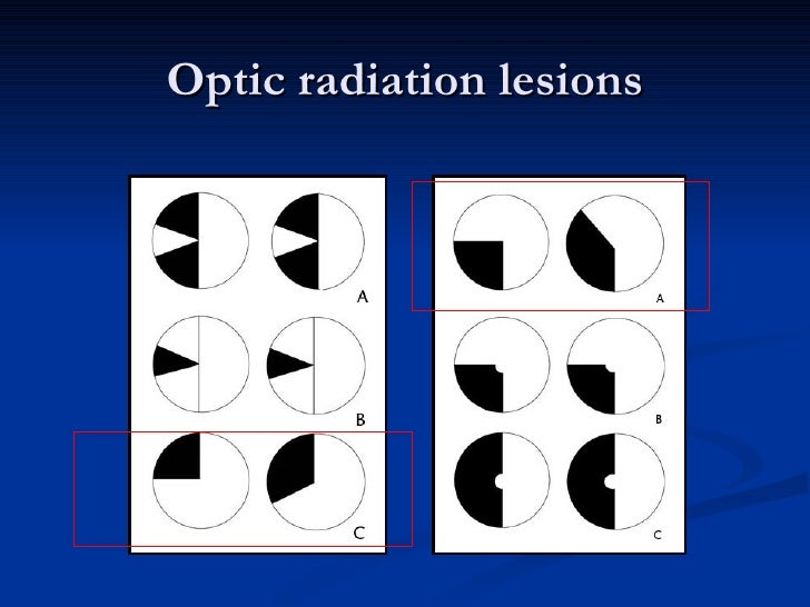 Anatomy and Lesions of Visual Pathways
