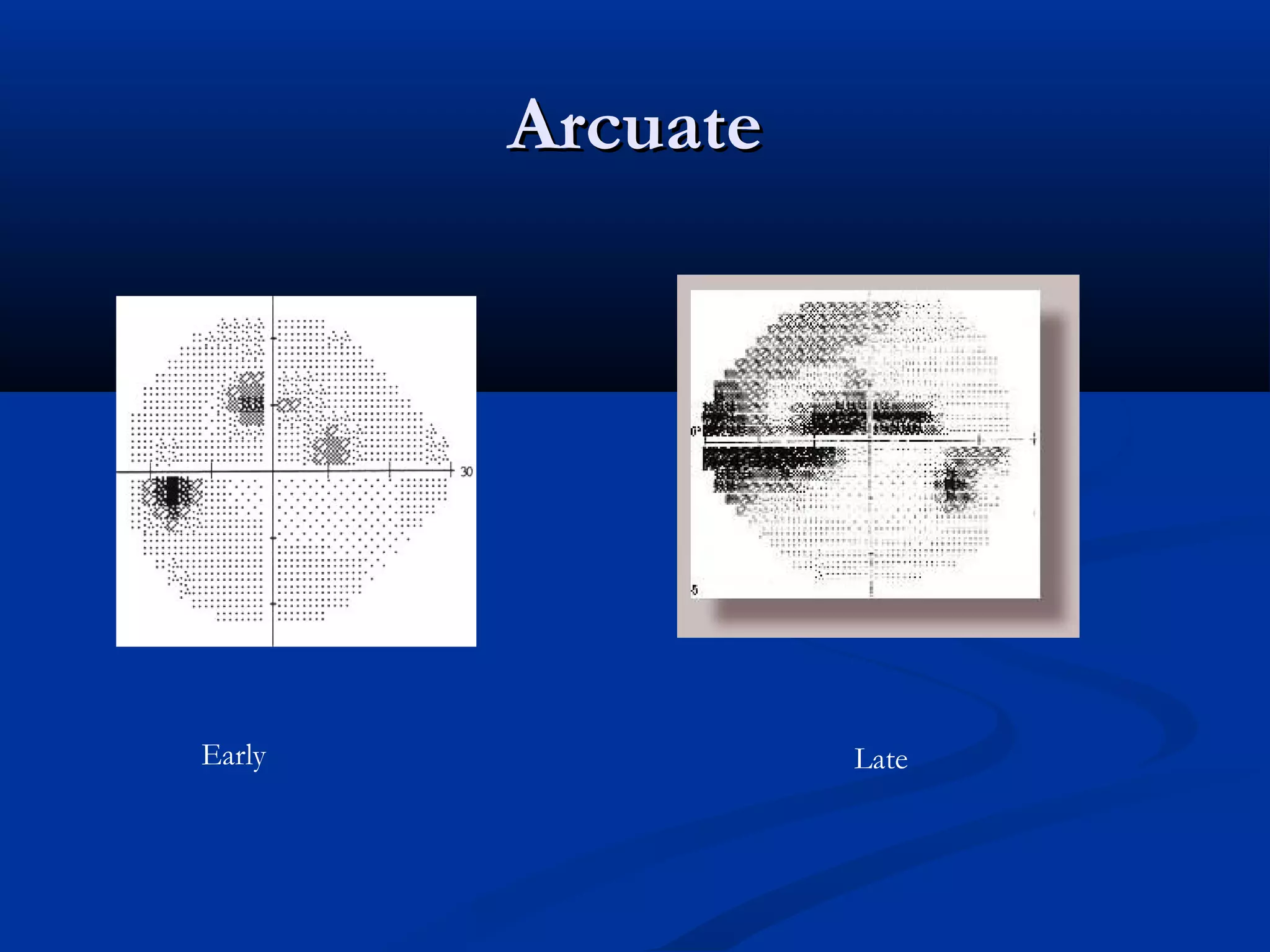 ArcuateArcuate
Early Late
 