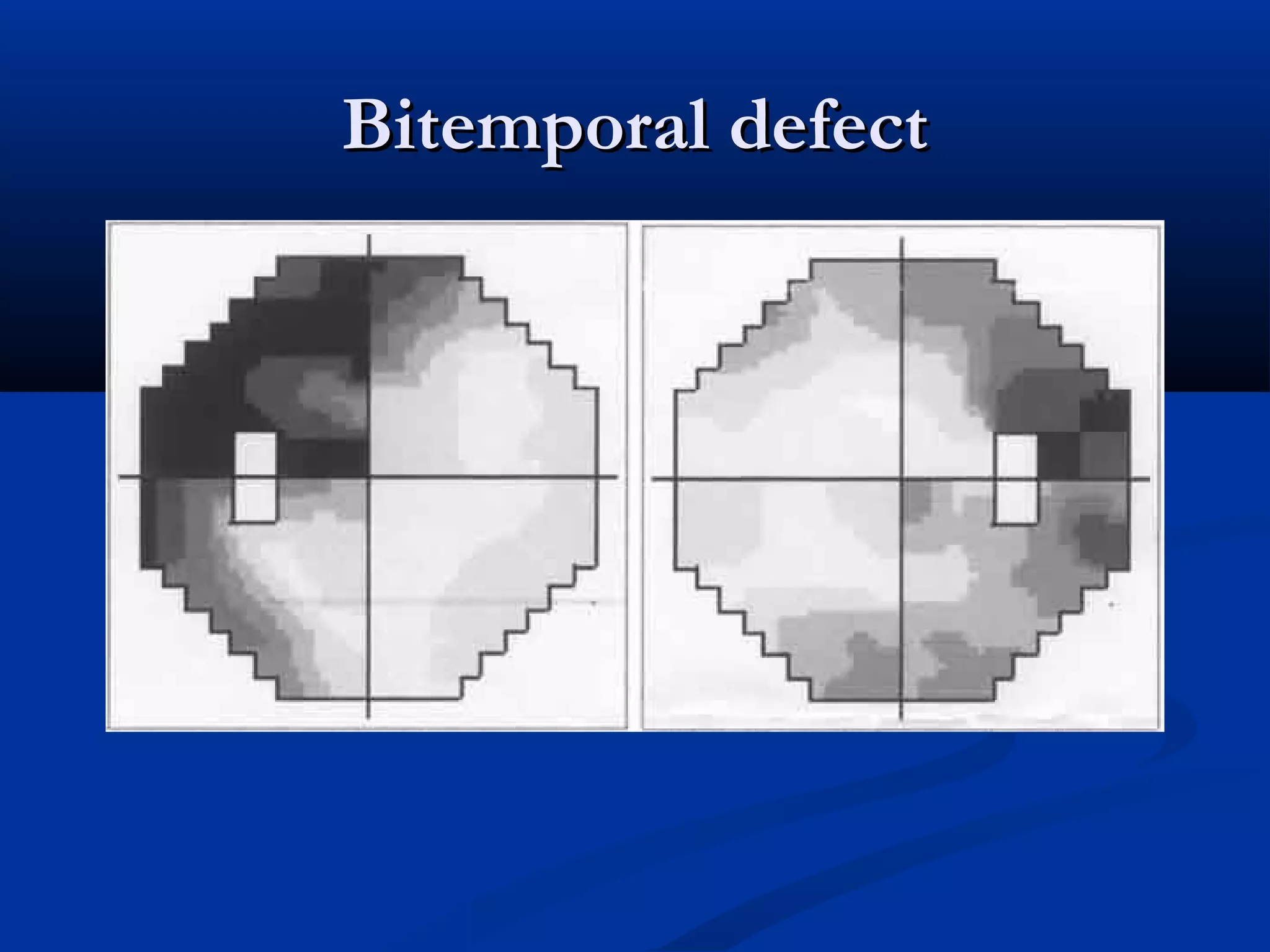Bitemporal defectBitemporal defect
 