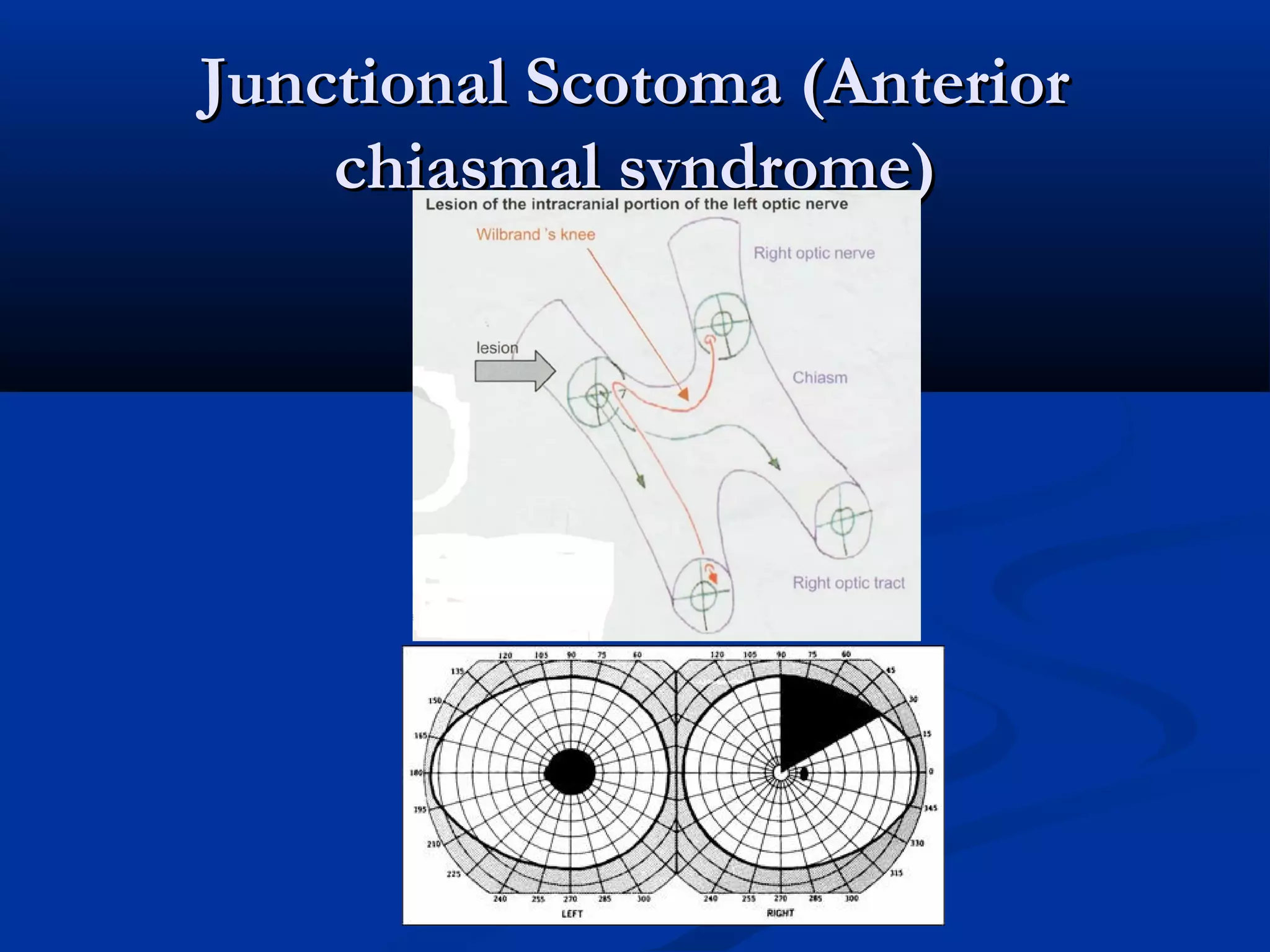 Junctional Scotoma (AnteriorJunctional Scotoma (Anterior
chiasmal syndrome)chiasmal syndrome)
 