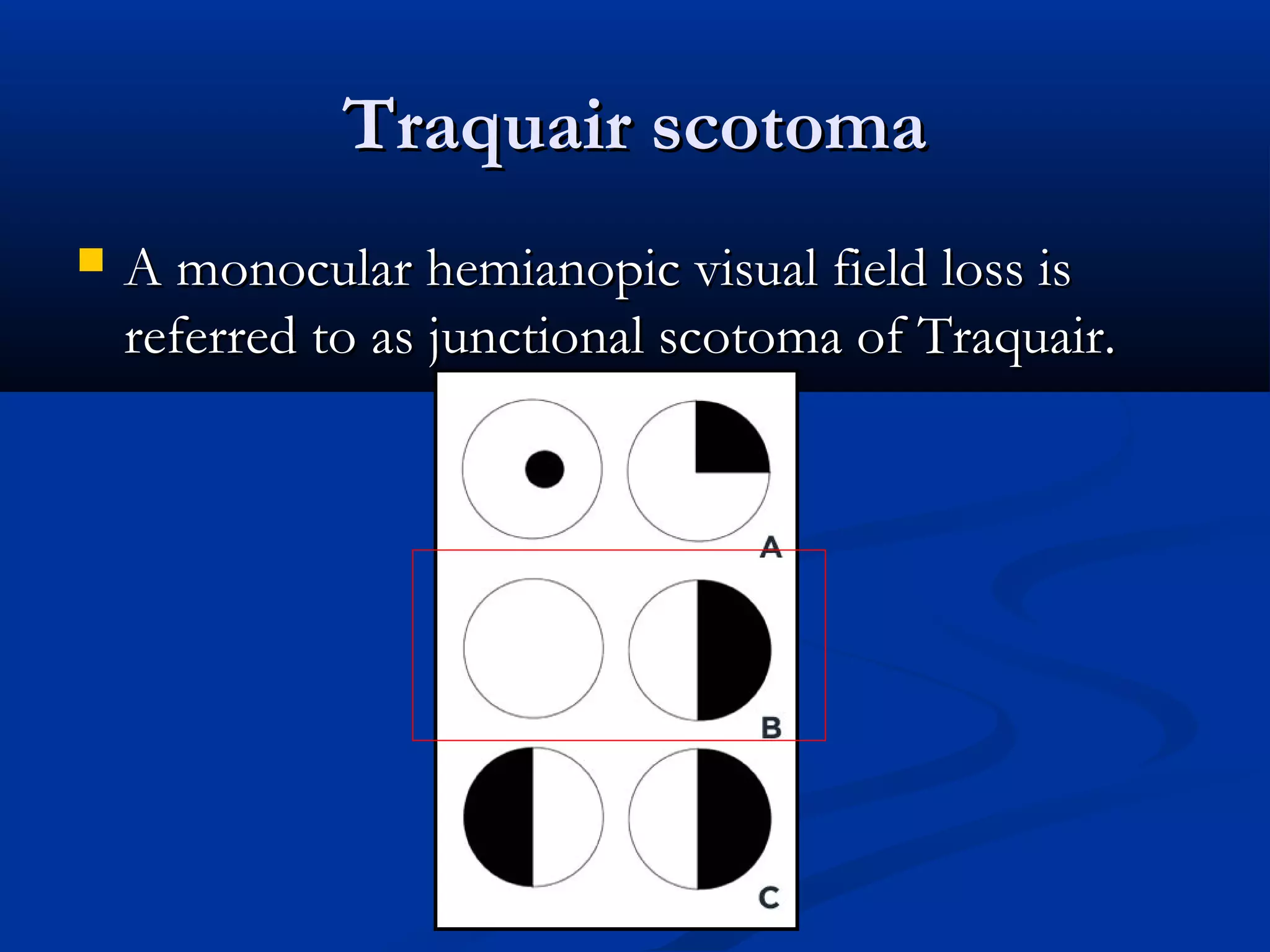 Traquair scotomaTraquair scotoma
 A monocular hemianopic visual field loss isA monocular hemianopic visual field loss is
referred to as junctional scotoma of Traquair.referred to as junctional scotoma of Traquair.
 