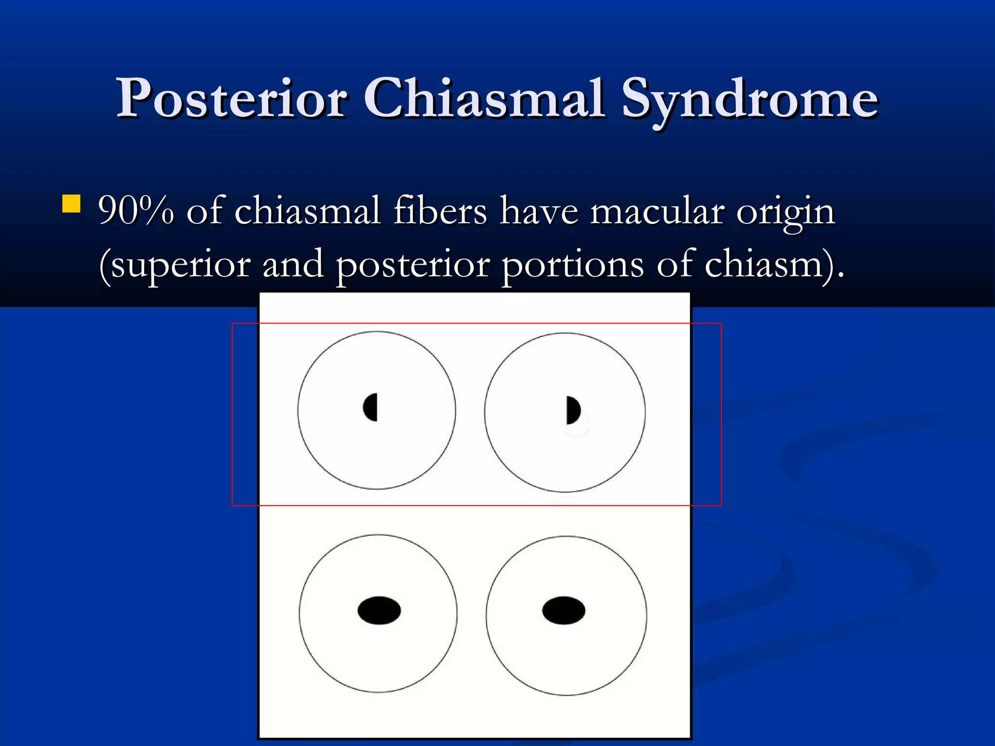 Posterior Chiasmal SyndromePosterior Chiasmal Syndrome
 90% of chiasmal fibers have macular origin90% of chiasmal fibers have macular origin
(superior and posterior portions of chiasm).(superior and posterior portions of chiasm).
 