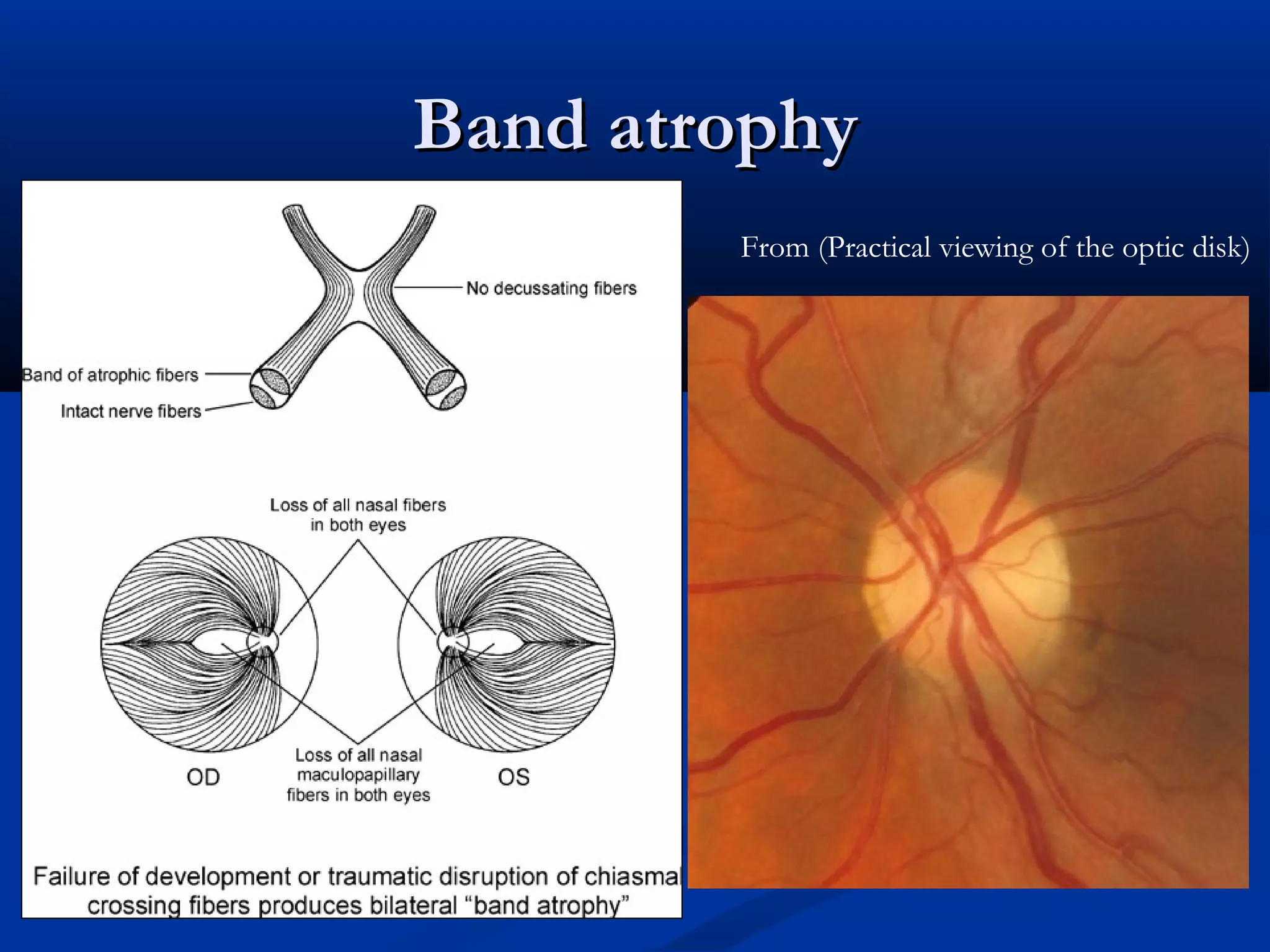 Band atrophyBand atrophy
From (Practical viewing of the optic disk)
 