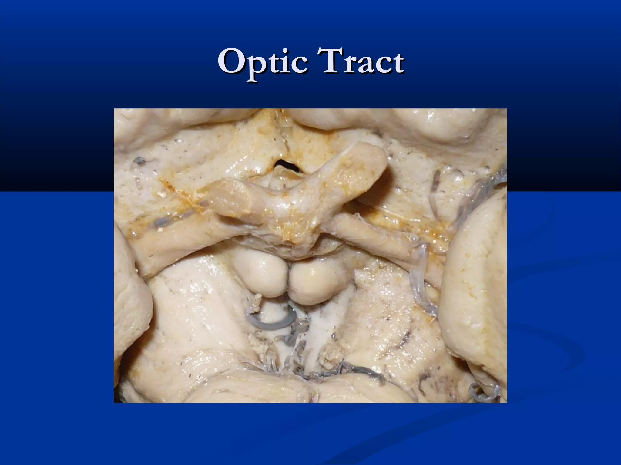 Optic TractOptic Tract
 