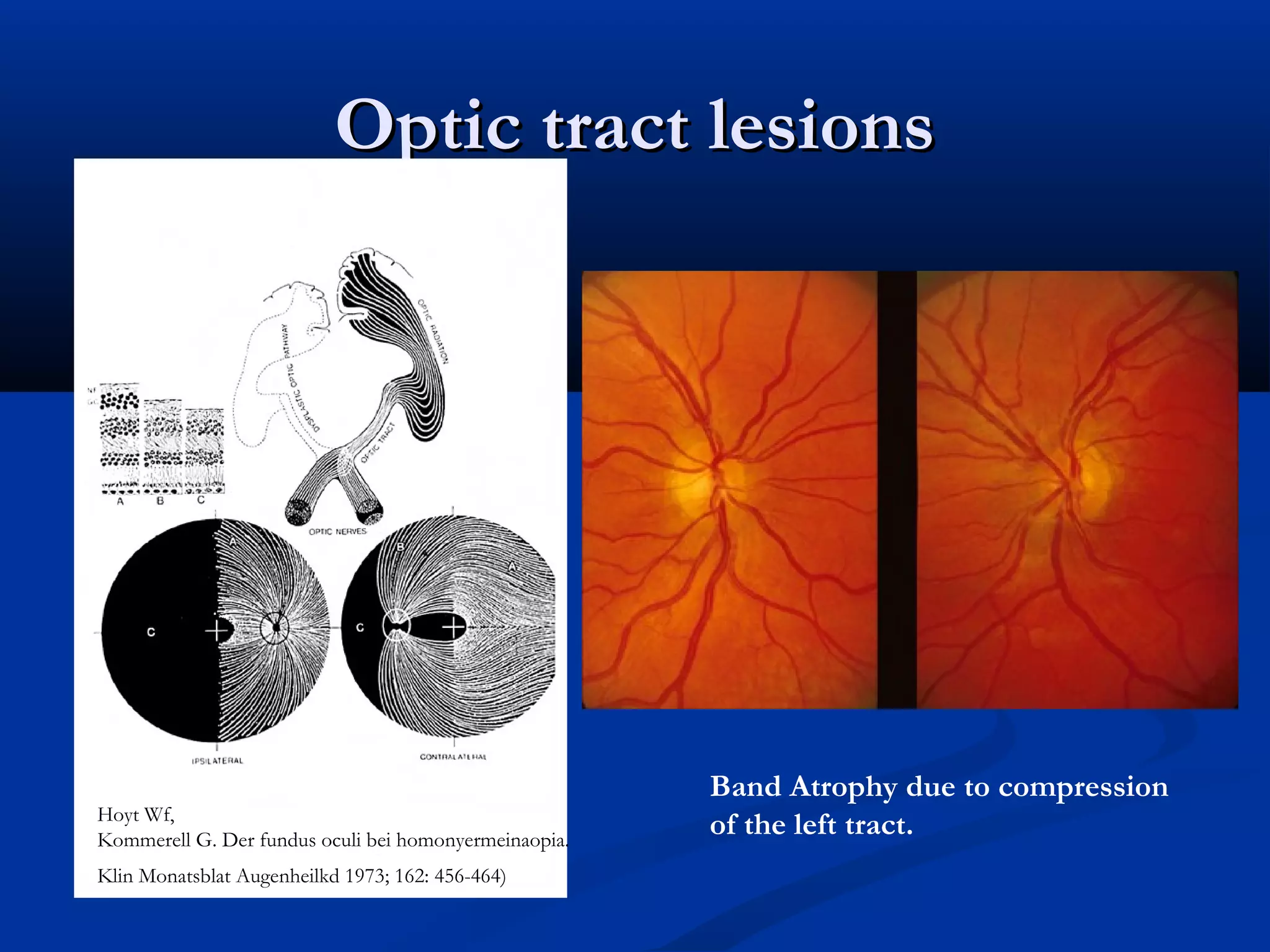 Optic tract lesionsOptic tract lesions
Band Atrophy due to compression
of the left tract.Hoyt Wf,
Kommerell G. Der fundus oculi bei homonyermeinaopia.
Klin Monatsblat Augenheilkd 1973; 162: 456-464)
 
