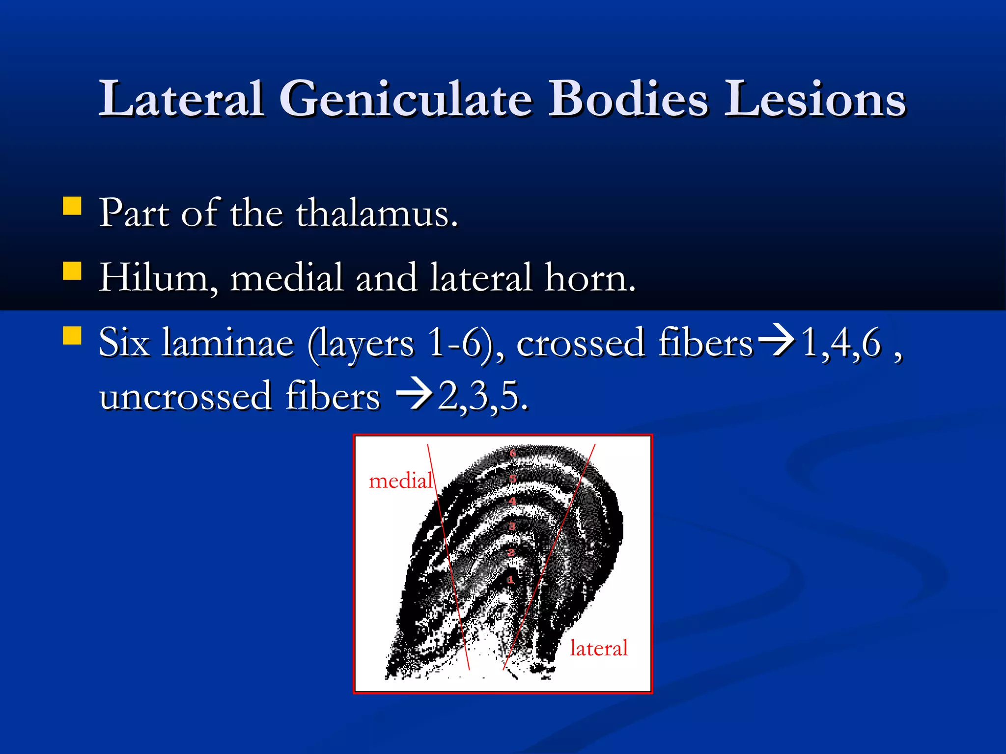 Lateral Geniculate Bodies LesionsLateral Geniculate Bodies Lesions
 Part of the thalamus.Part of the thalamus.
 Hilum, medial and lateral horn.Hilum, medial and lateral horn.
 Six laminae (layers 1-6), crossed fibersSix laminae (layers 1-6), crossed fibers1,4,6 ,1,4,6 ,
uncrossed fibersuncrossed fibers 2,3,5.2,3,5.
medial
lateral
 