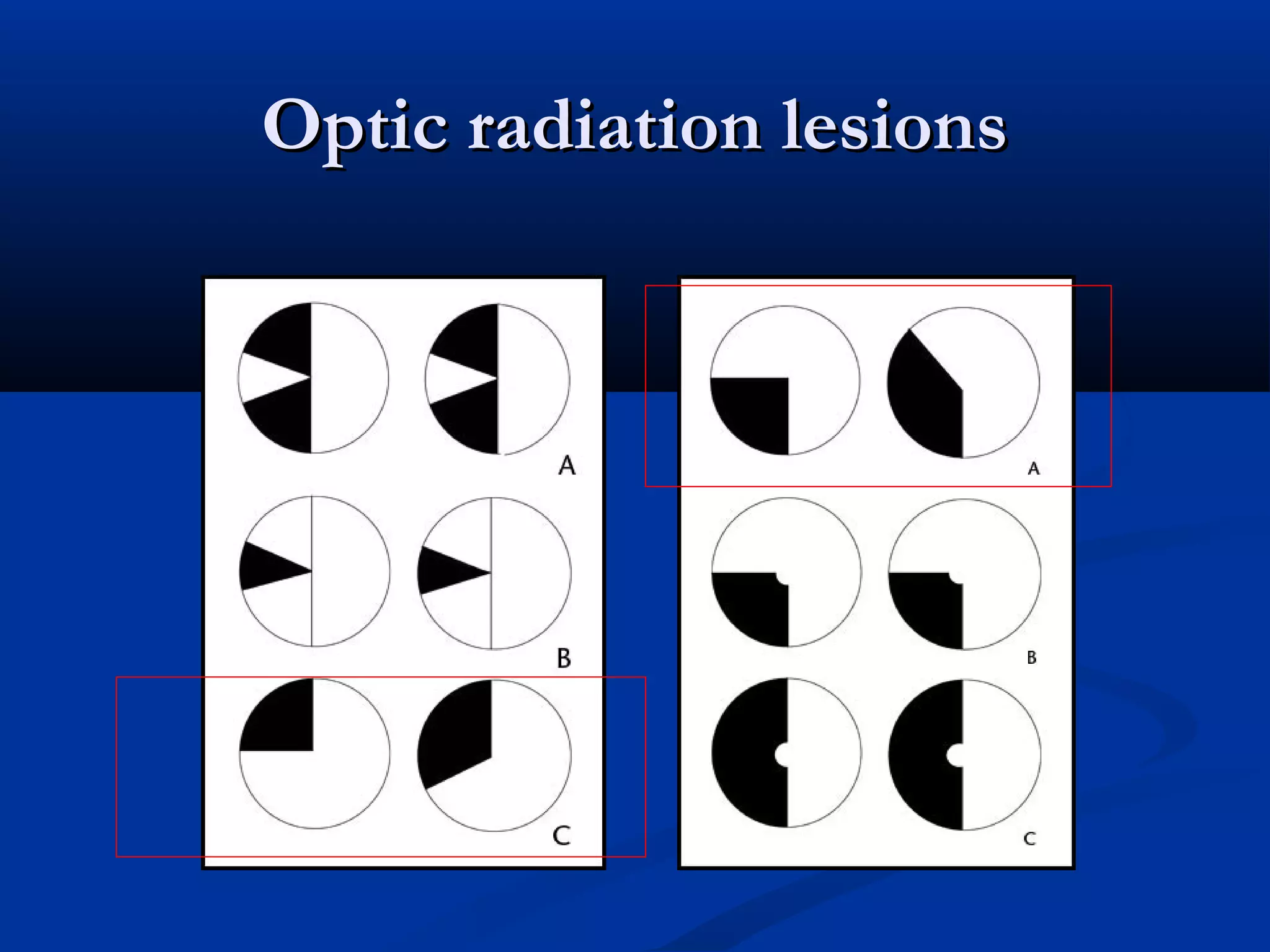 Optic radiation lesionsOptic radiation lesions
 