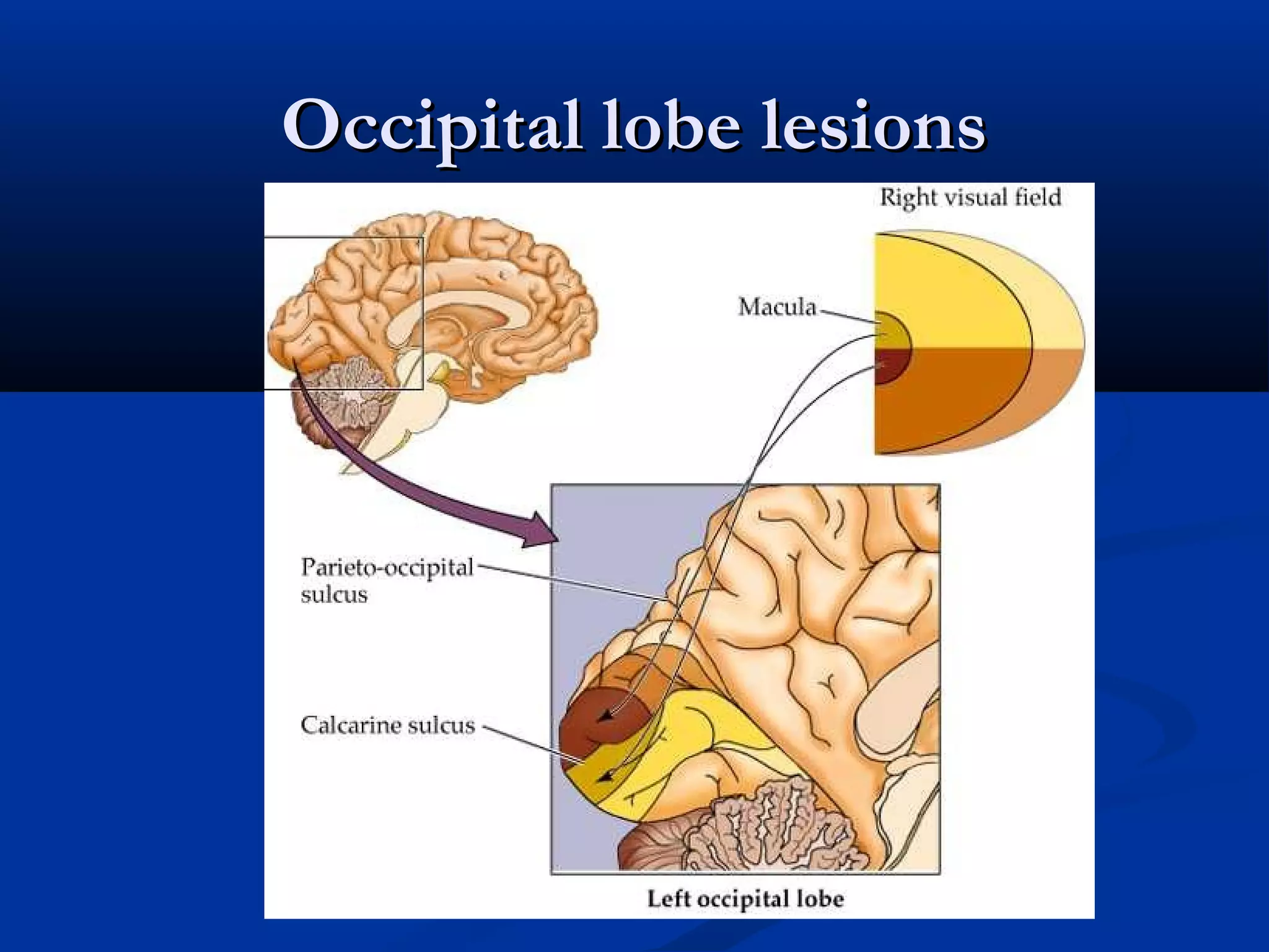 Occipital lobe lesionsOccipital lobe lesions
 