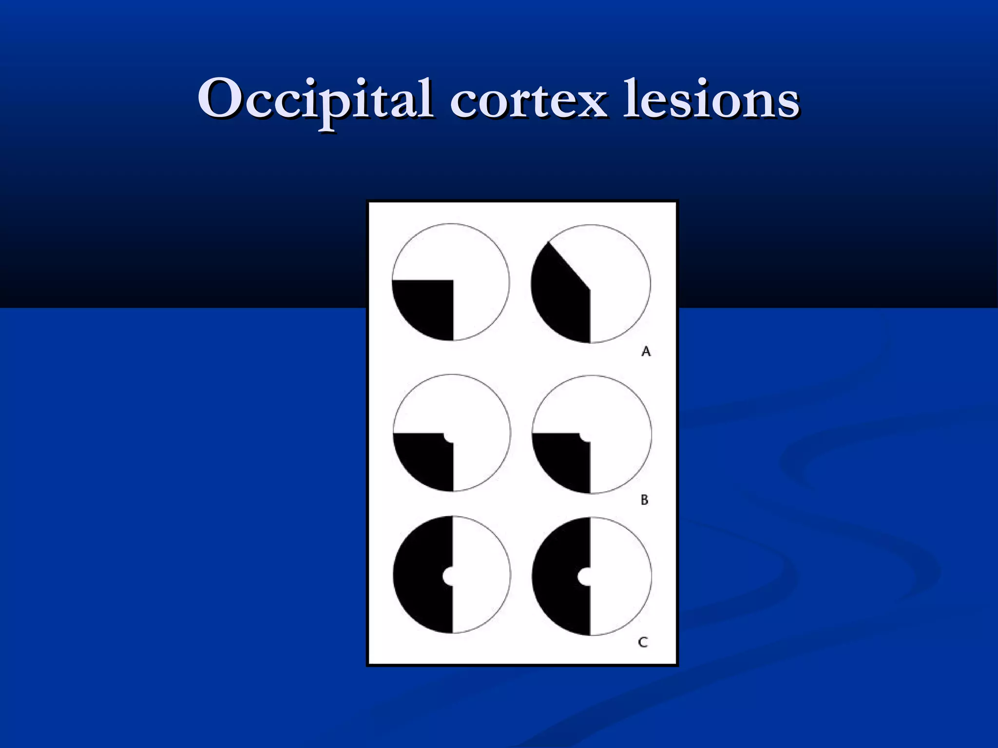 Occipital cortex lesionsOccipital cortex lesions
 