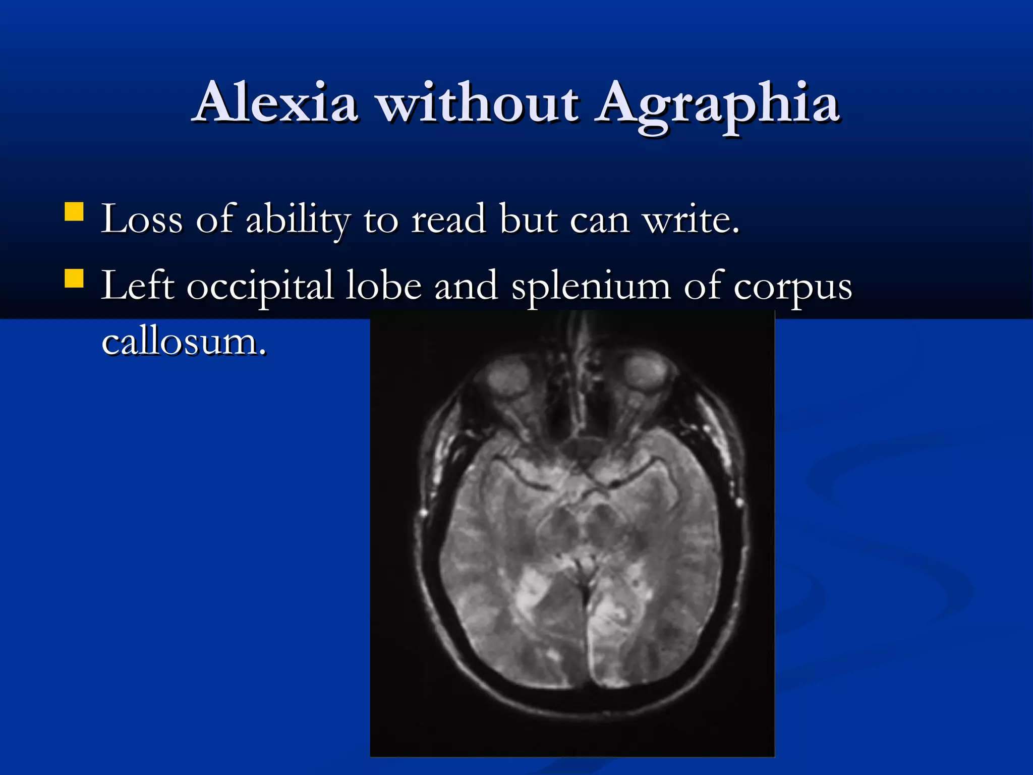 Alexia without AgraphiaAlexia without Agraphia
 Loss of ability to read but can write.Loss of ability to read but can write.
 Left occipital lobe and splenium of corpusLeft occipital lobe and splenium of corpus
callosum.callosum.
 