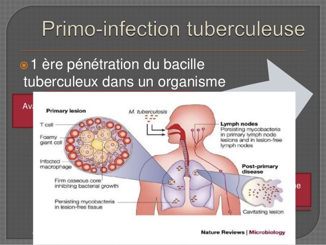 lymphoma types cancer poumon ganglion trachée