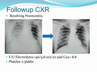 Followup CXR
 Resolving Pnemonitis.

 F/U Electrolytes-146/3.6/107/22 and Ca2+ 8.8
 Platelet-2.3lakhs
 