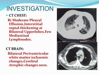 INVESTIGATION
 CT CHEST:
Rt Moderate Pleural
Effusion,Interstitial
septal thickening at
Bilateral Upperlobes.Few
Mediastinal
Lymphnodes.
CT BRAIN:
Bilateral Periventricular
white matter ischaemic
changes,Cerebral
Atrophic changes seen.
 