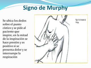 ¿Qué Es El Signo De Murphy? | El Signo De Murphy Pdf – VIDQMS