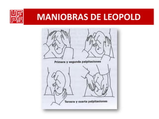 MANIOBRAS DE LEOPOLD
 