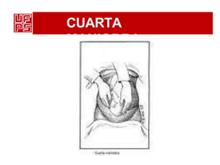 CUARTA
MANIOBRA
 