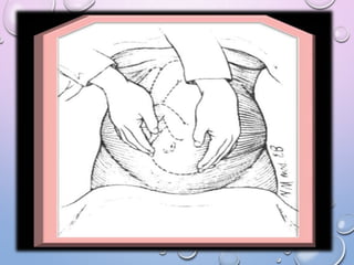 Maniobras de leopold