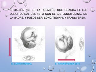 • SITUACIÓN (S): ES LA RELACIÓN QUE GUARDA EL EJE
LONGITUDINAL DEL FETO CON EL EJE LONGITUDINAL DE
LA MADRE, Y PUEDE SER: LONGITUDINAL Y TRANSVERSA.
S. LONGITUDINAL S. TRANSVERSA (ST)
 