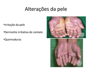 Alterações da pele
•Irritação da pele
•Dermatite irritativa de contato
•Queimaduras

 