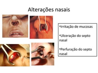 Alterações nasais
•Irritação de mucosas
•Ulceração do septo
nasal
•Perfuração do septo
nasal

 