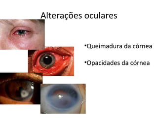Alterações oculares
•Queimadura da córnea
•Opacidades da córnea

 