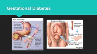 Gestational Diabetes
 