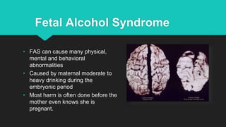 Fetal Alcohol Syndrome
• FAS can cause many physical,
mental and behavioral
abnormalities
• Caused by maternal moderate to
heavy drinking during the
embryonic period
• Most harm is often done before the
mother even knows she is
pregnant.
 